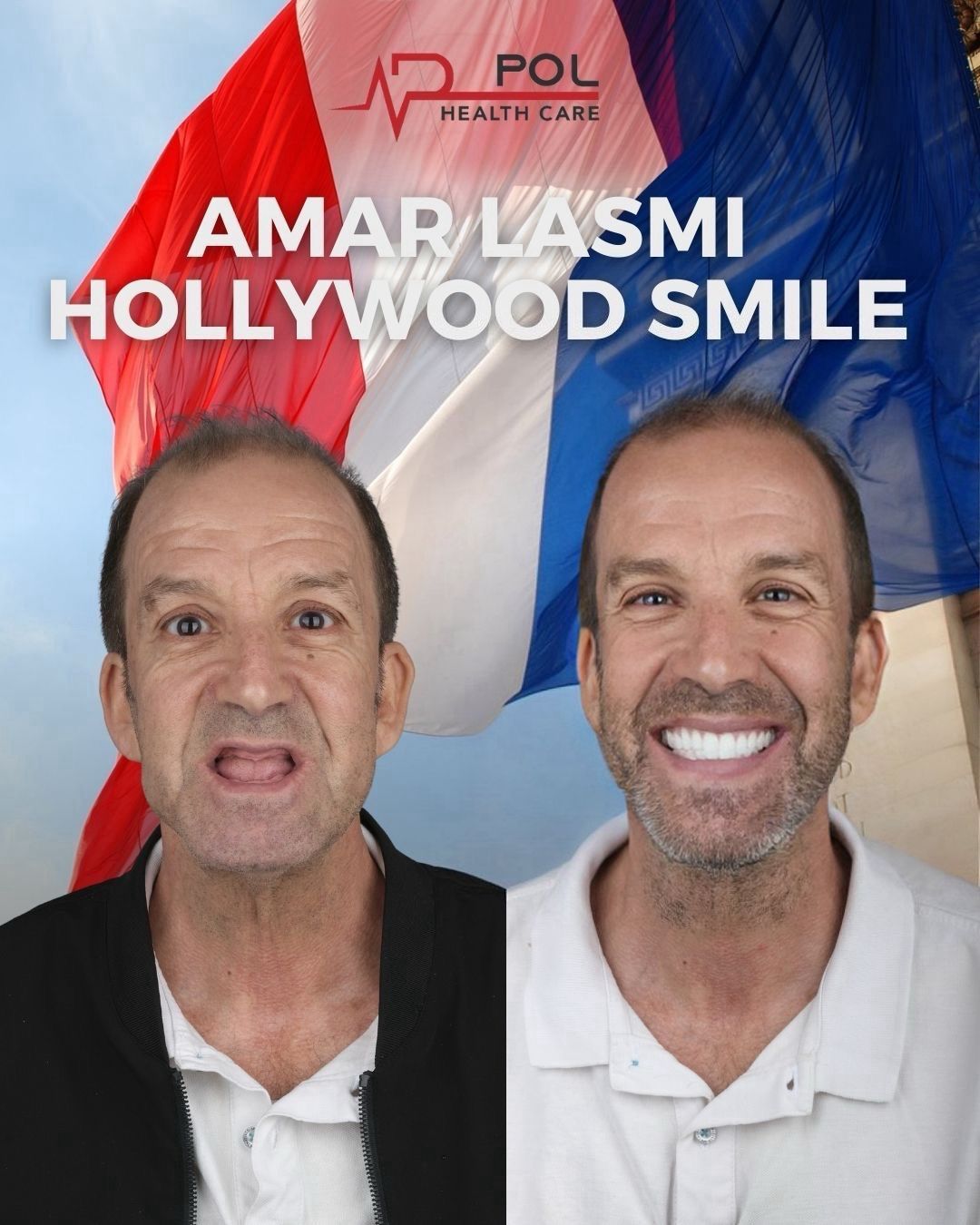 Before and after: Hollywood Smile · Patient from France