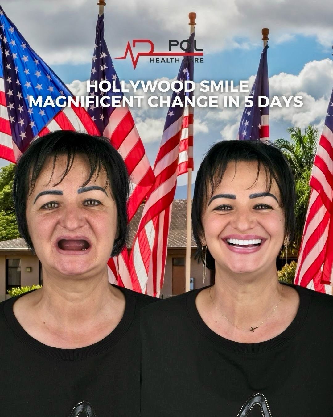 Before and after: Hollywood Smile in 5 days · Patient from the USA