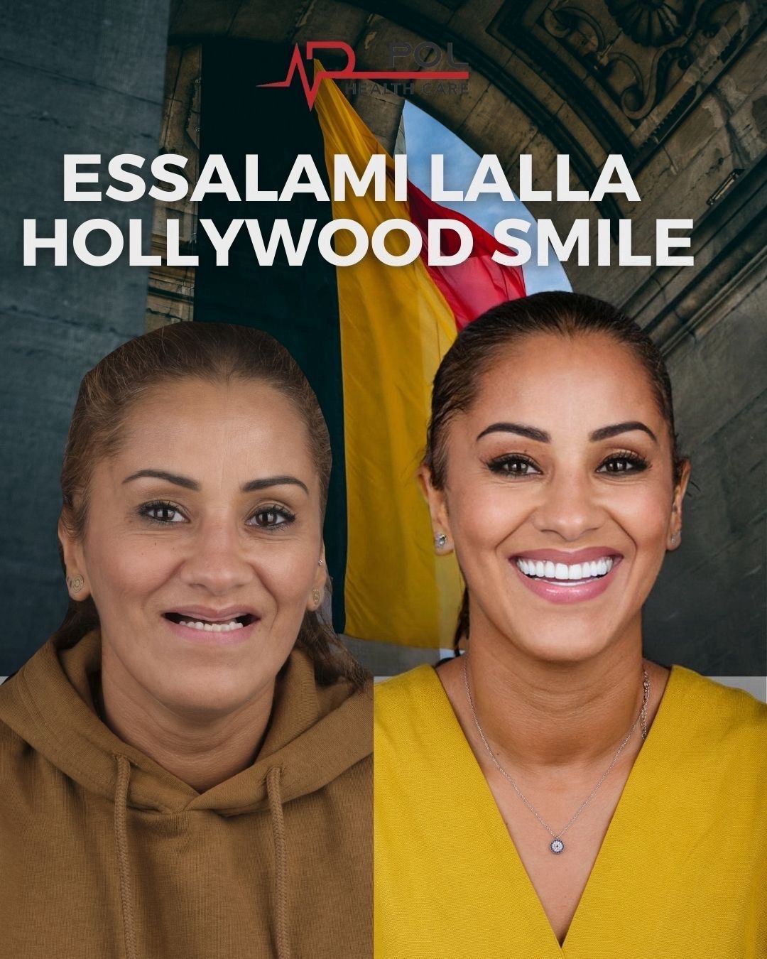 Before and after: Hollywood Smile · Patient from Belgium