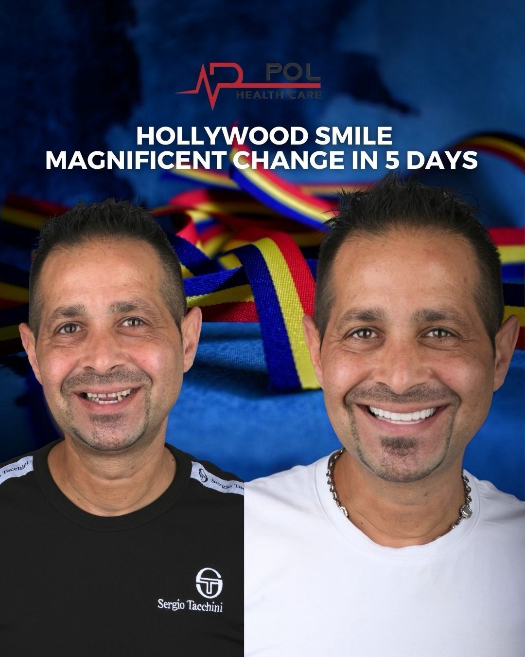 Before and after: Hollywood Smile in 5 days · Patient from Romania