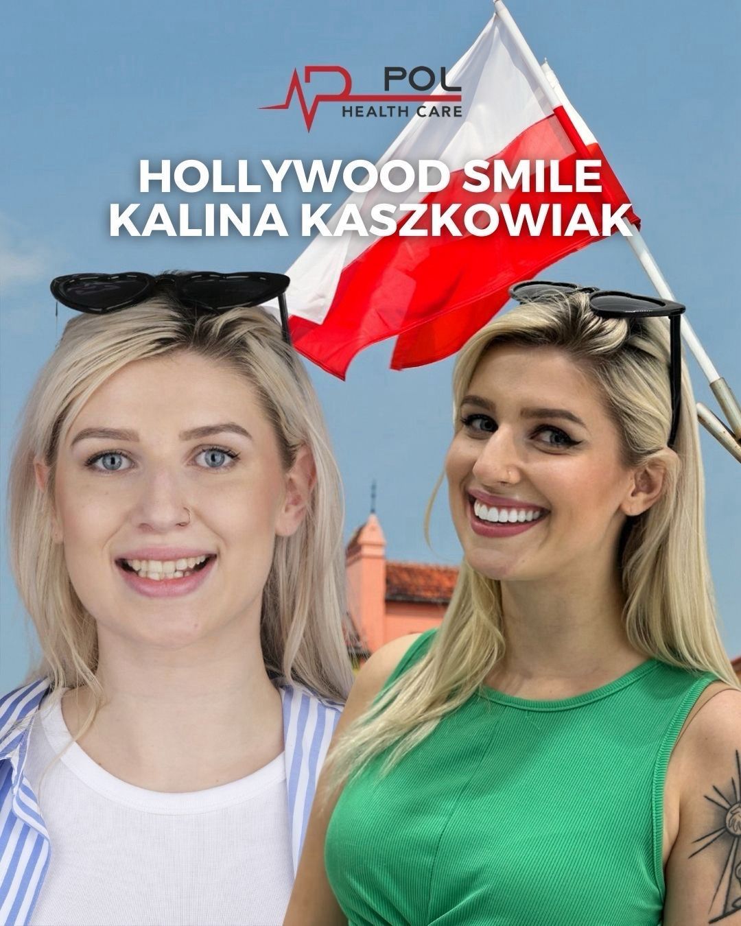 Before and after: Hollywood Smile · Patient from Poland