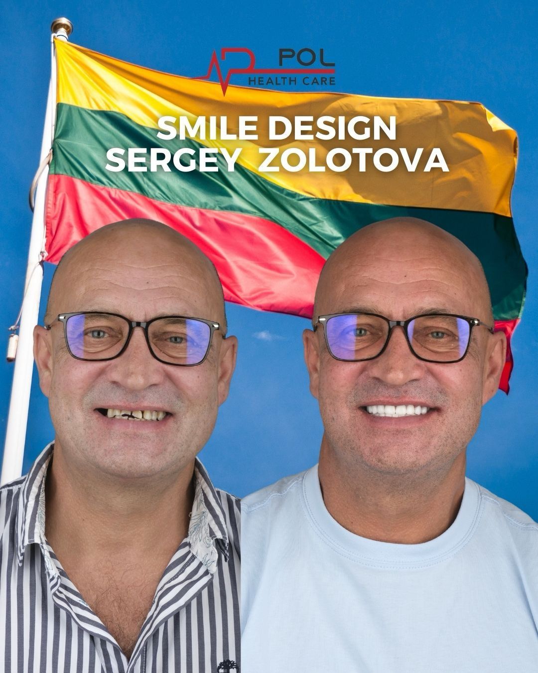 Before and after: Smile Design · Patient from Lithuania